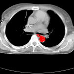 Example of Region Growing in Mamma-CT